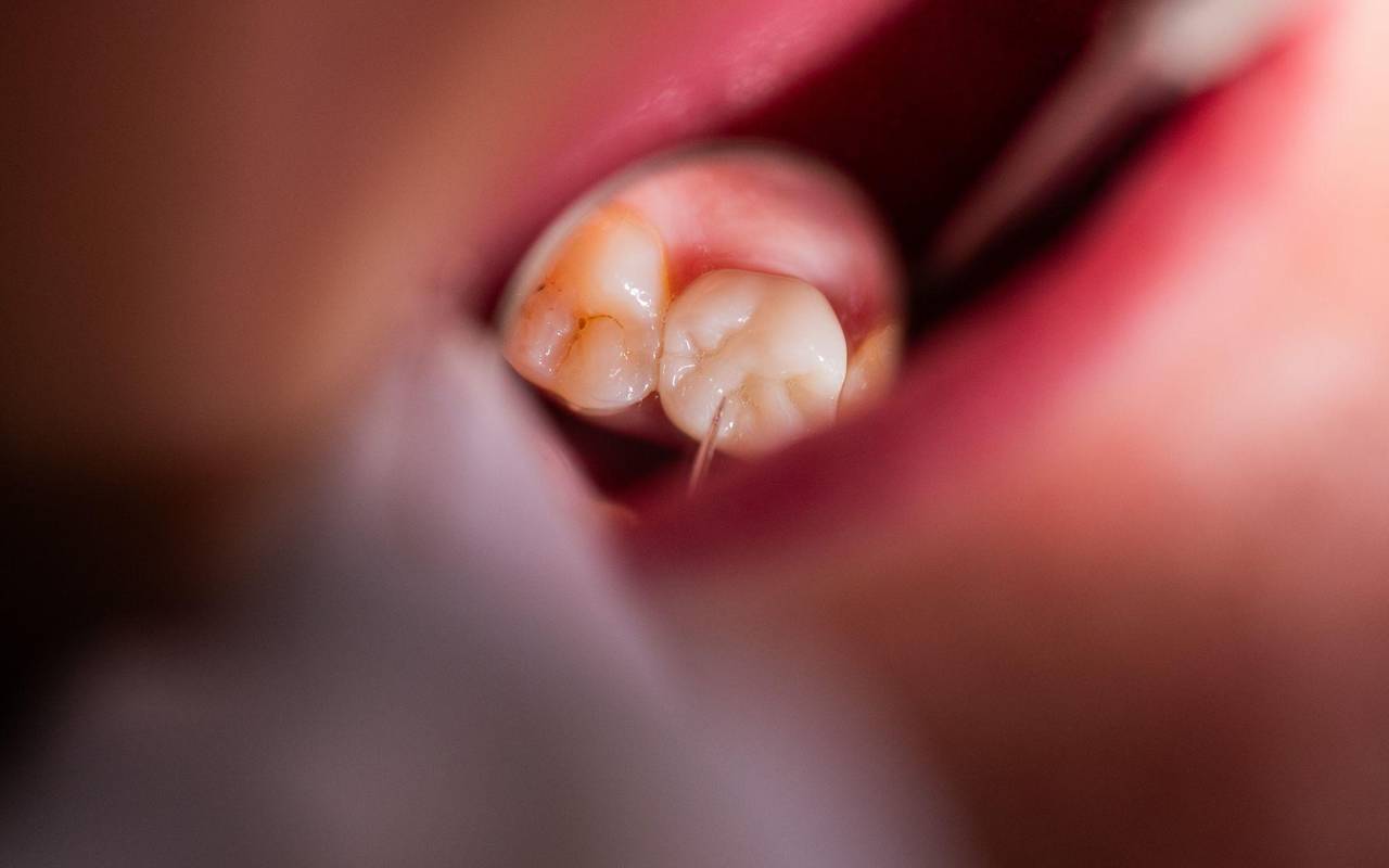 Zahnarzt schaut sich Zirkon-Vollkeramikkrone einer Patientin an