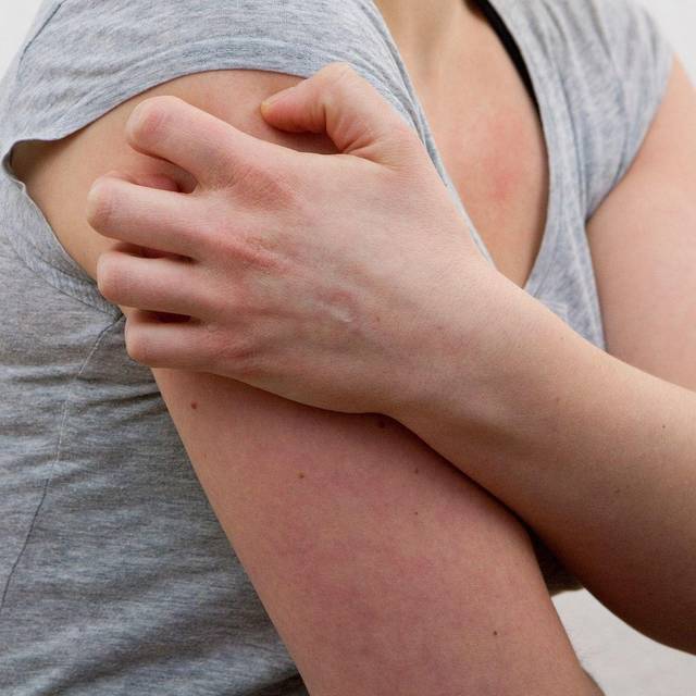 Eine Frau kratz sich am Oberarm