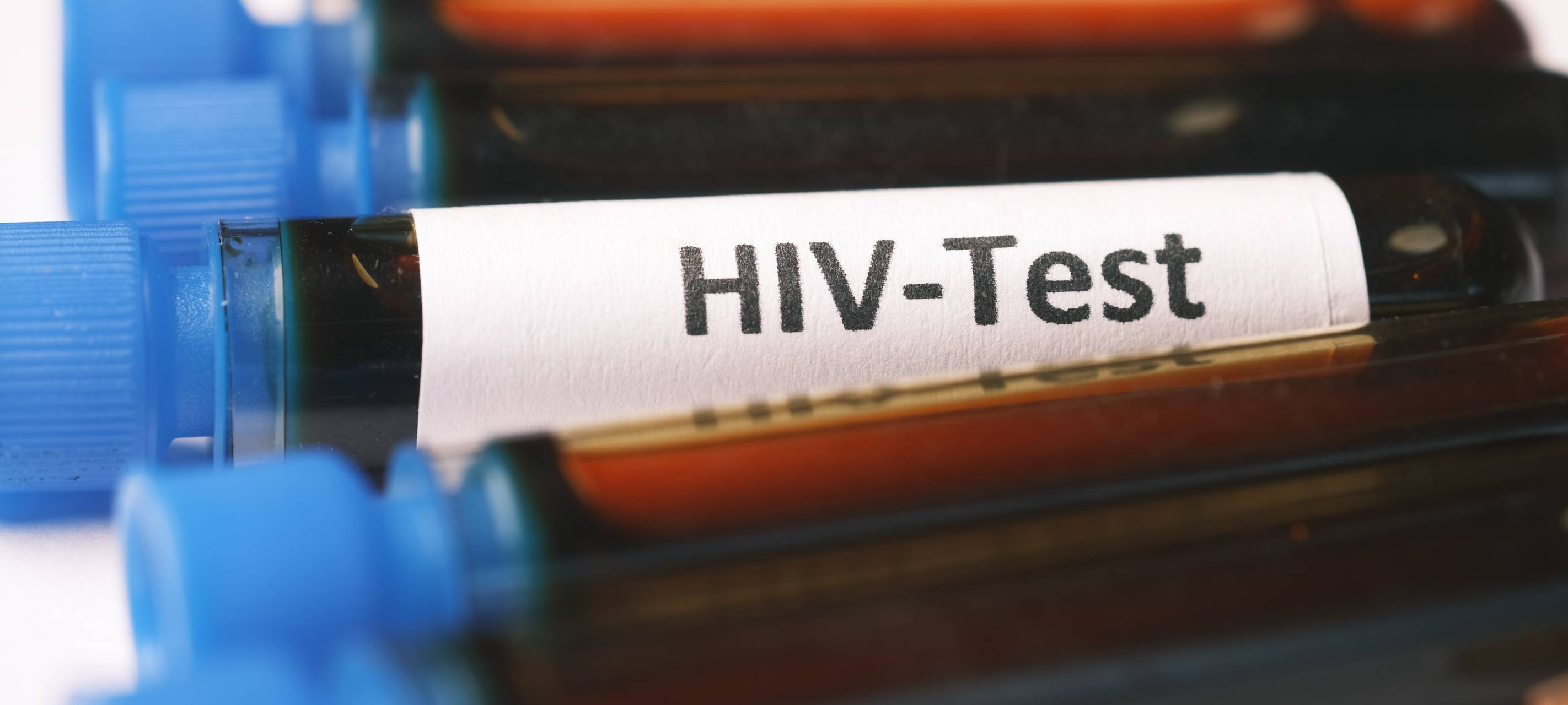 Weiter steigende Anzahl der HIV-Infektionen